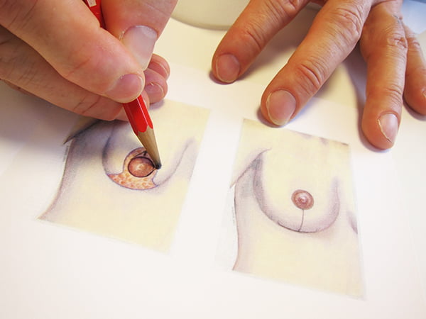 Brustverkleinerung: Skizze der Brustwarzenverschiebung (Breast Atelier Zürich)