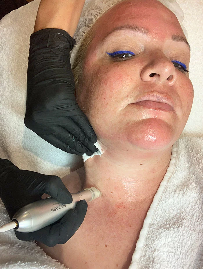 Microneedling Treatment4 During