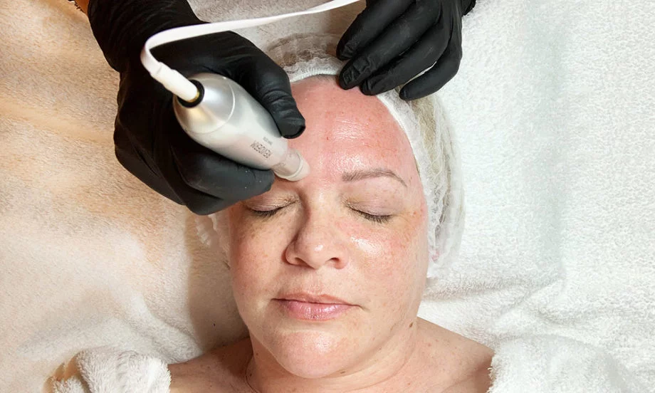 Der grosse Selbsttest: Microneedling bei Beauty Care Zürich Microneedling: Der grosse Erfahrungsbericht auf Hey Pretty: 3 Monate Treatments und das Fazit 9 Monate danach