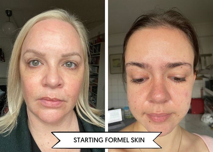 Formelskin Resultate Vorher