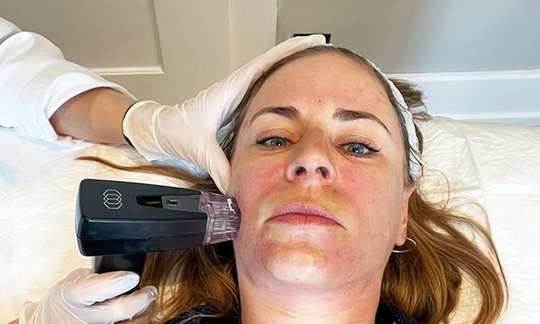 Erfahrungsbericht des Deep Needling Treamtents Morpheus8: Was kann das neue, tifenwirksame Microneedling anders, und warum ist mit einer PRP Behandlung noch wirksamer? – Hey Pretty Beauty Blog Review