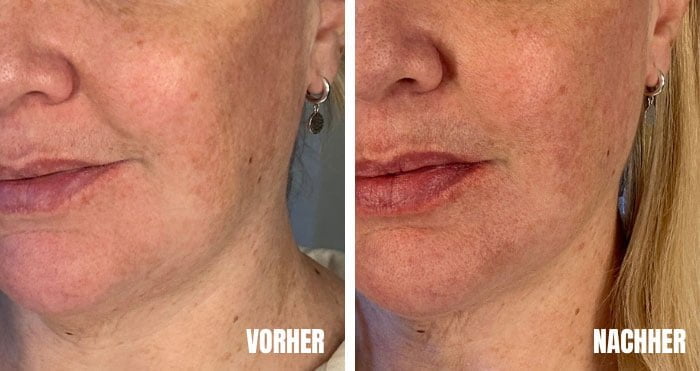 Die erste lymphatische Hautpflege der Welt: IRAYE Skincare 15 VorherNachher ThisOne