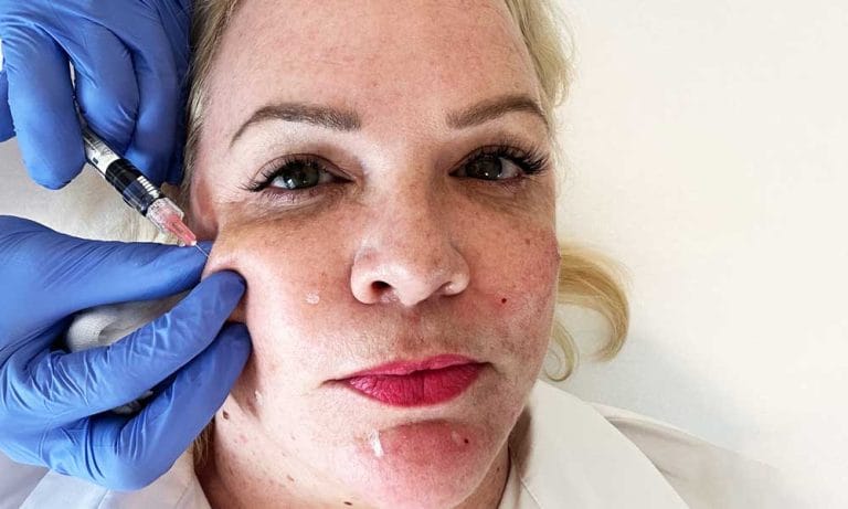 Selbsttest: Profhilo Skinbooster bei der Dermis Hautklinik in Zürich Seefeld (Hey Pretty Beauty Magazin Erfahrungsbericht)