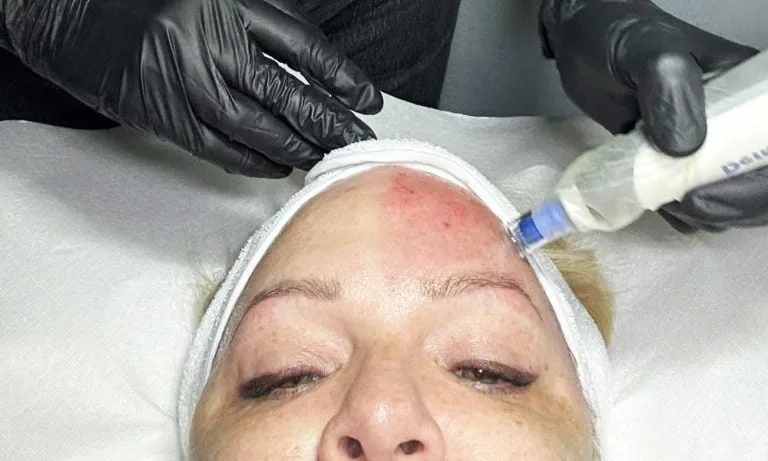 Teaser Microneedling 1