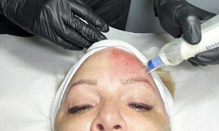 Teaser Microneedling 1