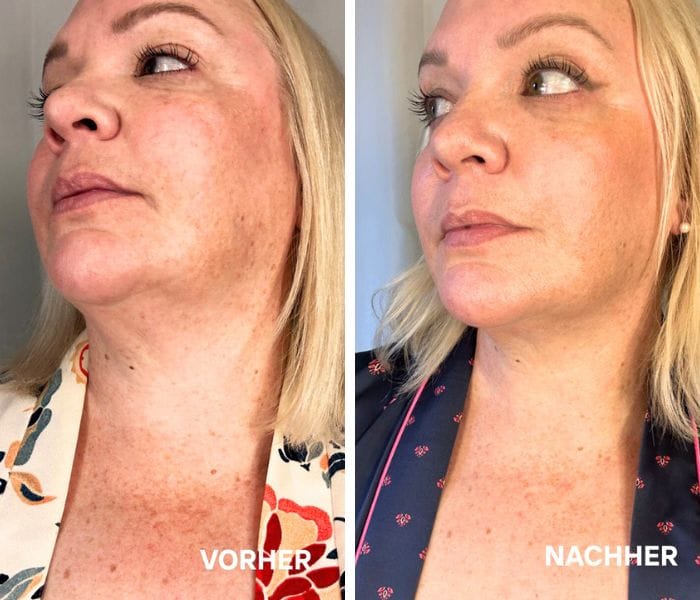 Meine CurrentBody Skin LED Maske-Liebesgeschichte – mit Update für Hals & Dekolleté! 7 Currentbody VorherNachher Pic