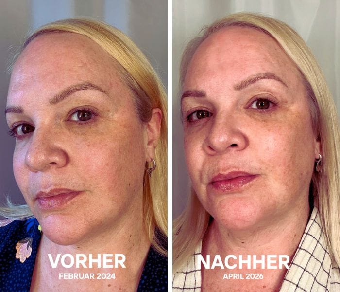 5 Gründe, warum ich immer wieder zu meiner CurrentBody Skin LED Rotlicht Therapie Gesichtsmaske greife 2 Currentbody VorherNachher 2026