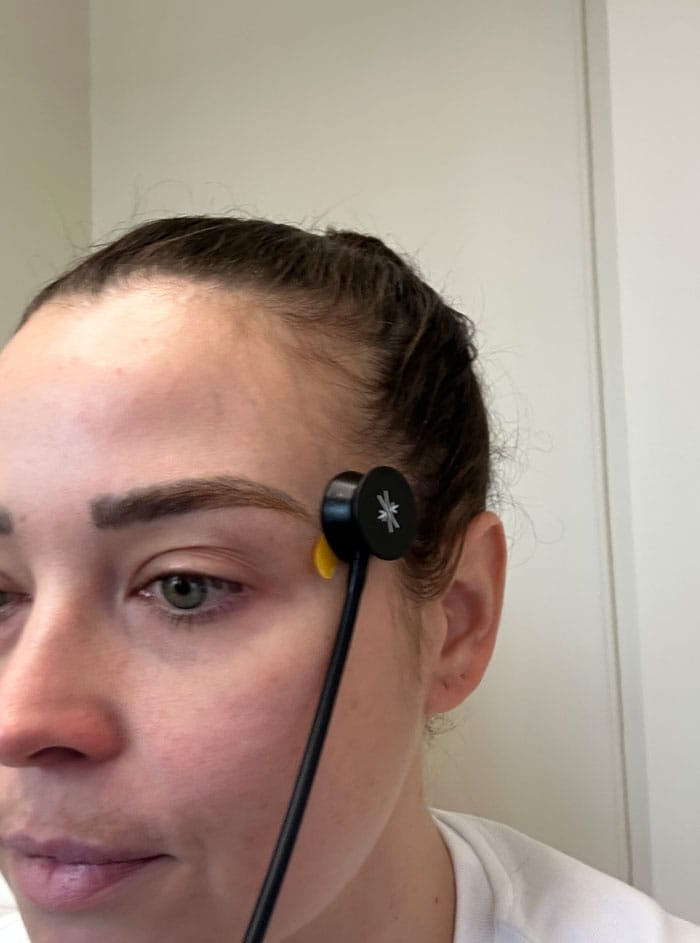 Besser als Morpheus8? Wir testen das Vivace RF Microneedling bei everskin 15 everskin vivace hautanalyse nathi