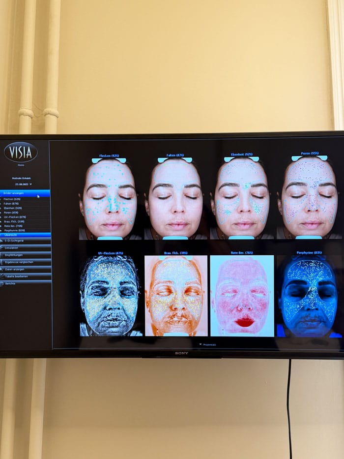 Besser als Morpheus8? Wir testen das Vivace RF Microneedling bei everskin 16 everskin vivace hautanalyse resultate nathalie