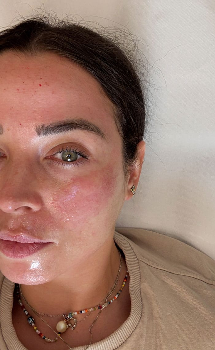 Besser als Morpheus8? Wir testen das Vivace RF Microneedling bei everskin 8 everskin vivace treatment 1 nachher