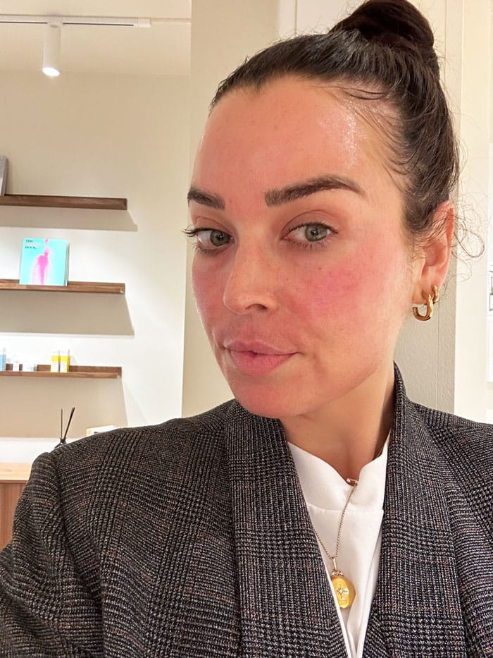 Besser als Morpheus8? Wir testen das Vivace RF Microneedling bei everskin 9 everskin vivace treatment 2 nachher