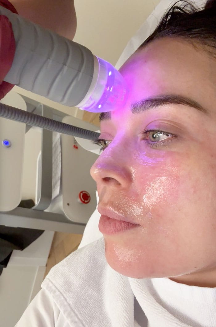 Besser als Morpheus8? Wir testen das Vivace RF Microneedling bei everskin 6 everskin vivace treatment waehrend 1