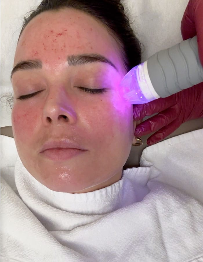 Besser als Morpheus8? Wir testen das Vivace RF Microneedling bei everskin 7 everskin vivace treatment waehrend 2